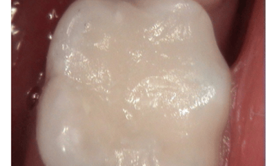 After treatment - Amalgam Removal