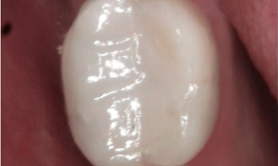 After treatment - Amalgam Removal 