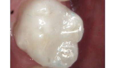 After treatment - Amalgam Removal