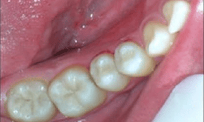 After treatment - Amalgam Removal