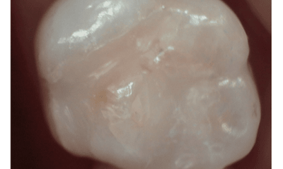 After treatment - Amalgam Removal