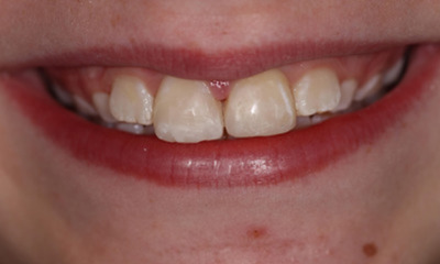 After treatment - Anterior Bonding