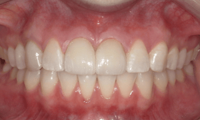 After treatment - Anterior Crown Restoration