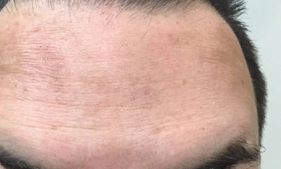 botox treatment- after photo