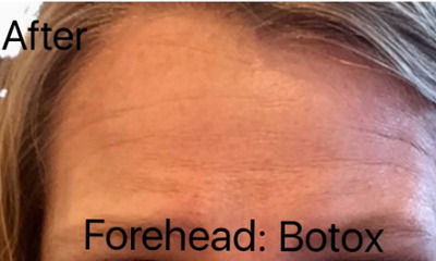 botox treatment- after photo