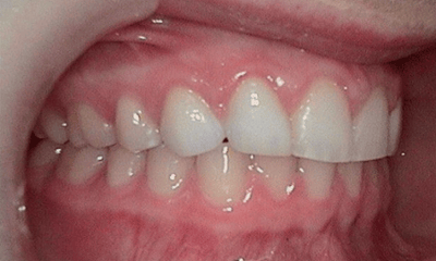 After treatment - Veneers
