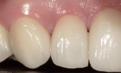 After treatment - Veneers