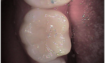 After treatment - Composite Tooth Filling