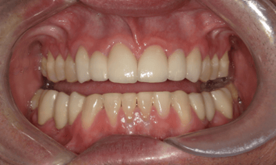 After treatment - Crown & Bridge