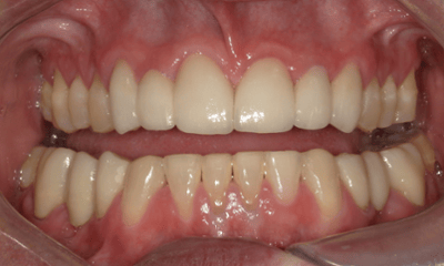After treatment - Crown and Bridge