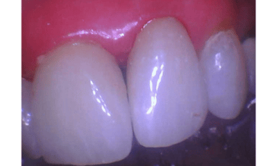 After treatment - Crowns