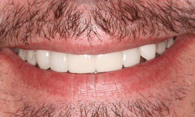 After treatment - Crowns