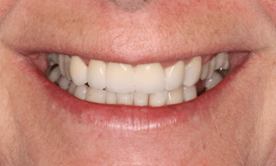 After treatment - Crowns