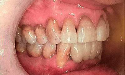 After treatment - Lower Implant Bridge