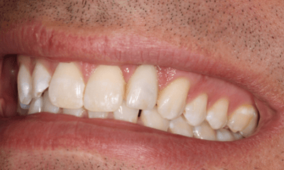After treatment - Dental Implants
