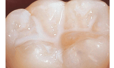 After treatment - Dental Sealants