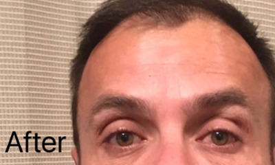 botox treatment- after photo