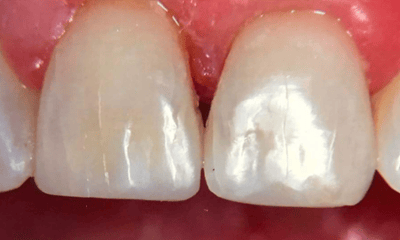 After treatment - Front Teeth Bonding