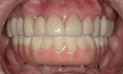 After treatment - Upper Crowns & Bridges with Lower Implant Hybrid Bridge 