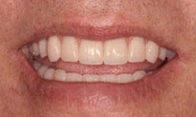 After treatment - Hybrid Dental Implants