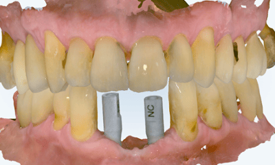 After treatment - Implant Bridge