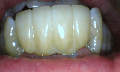 After treatment - Implant Bridge