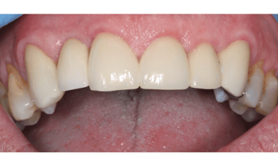 After treatment - Crowns & Implant 