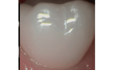 After treatment - Implant Natural Look