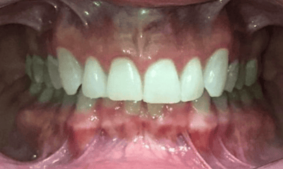 After treatment - Invisaligh and Gum Recontouring
