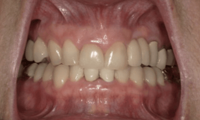 After treatment - Invisalign & Crown