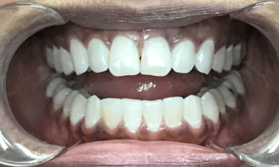 After treatment - Invisalign Black Triangle
