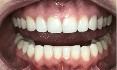 After treatment - Invisalign Crowding & Single Tooth Crossbite