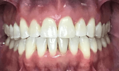 After treatment - Invisalign Crowding