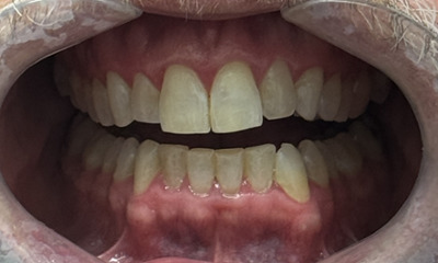 After treatment - Invisalign & Bonding
