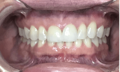 After treatment - Invisalign & Crowns Combo