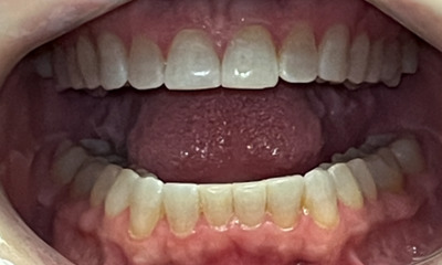 After treatment - Invisalign-relapse