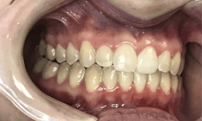 After treatment - Invisalign Rotation Crossbite