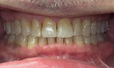 After treatment - Invisalign, Whitening, & Bonding
