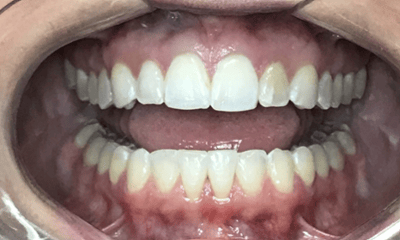 After treatment - Invisalign & Whitening