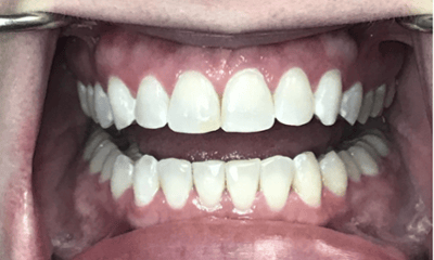 After treatment - Invisalign & Whitening