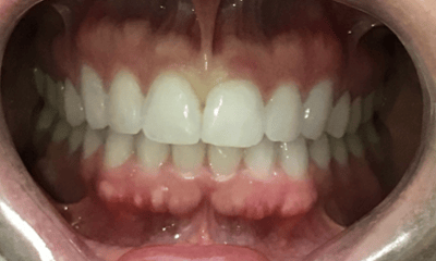 After treatment - Invisalign