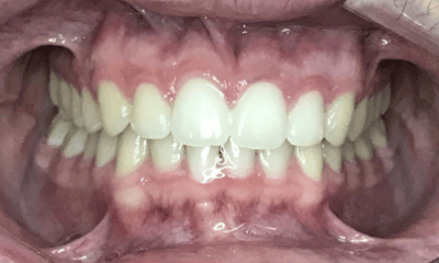 After treatment - Invisalign