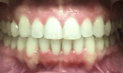 After treatment - Invisalign