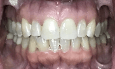 After treatment - Invisalign