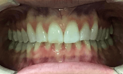After treatment - Invisalign