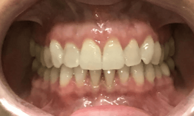 After treatment - Invisalign
