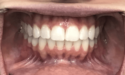 After treatment - Invisalign