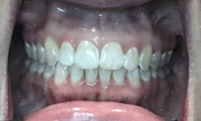 After treatment - Invisalign