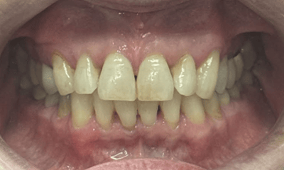 After treatment - Invisalign