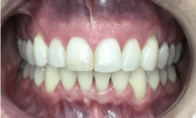 After treatment - Invisalign & Anterior Bonding 